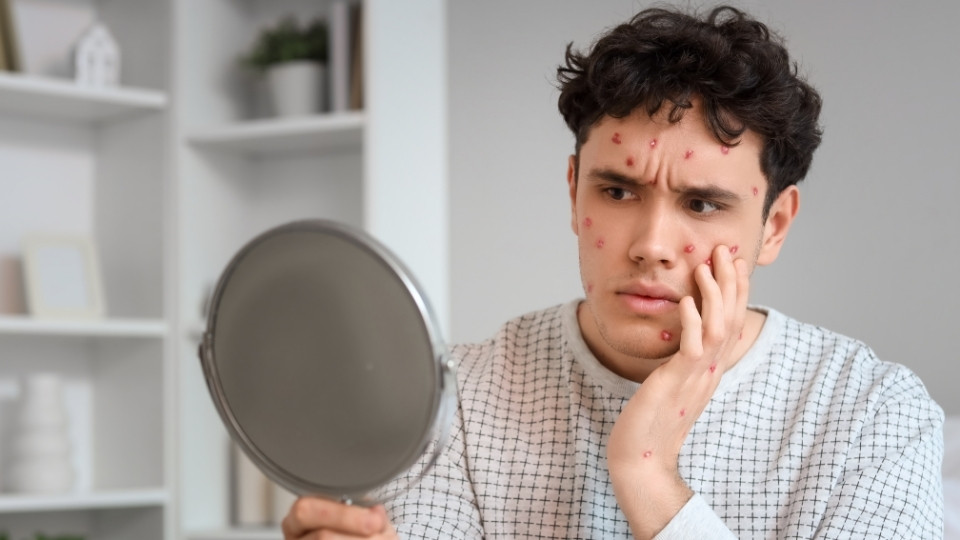 chickenpox symptoms