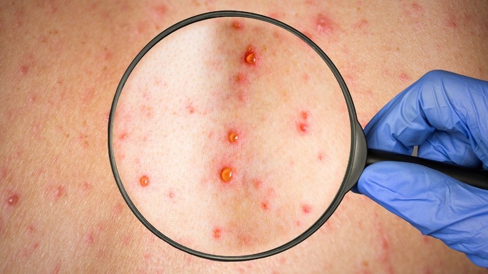 chickenpox symptoms
